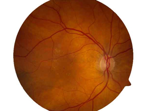 Bild eines Auges mit diabetischem Makulaödem