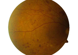 Bild eines Auges mit diabetischer Retinopathie