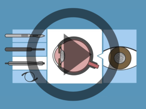 Grafik von Auge im Querschnitt auf blauem Hintergrund mit halbtransparentem Play-Button über die Grafik