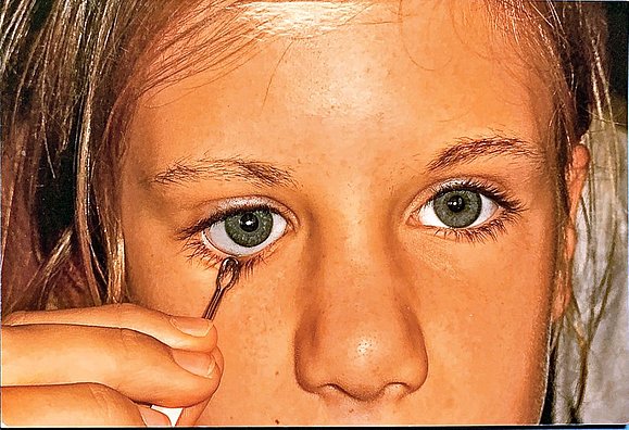 Eine Frau mit grünen Augen entnimmt mit einer Pinzette ihre Augenprothese.
