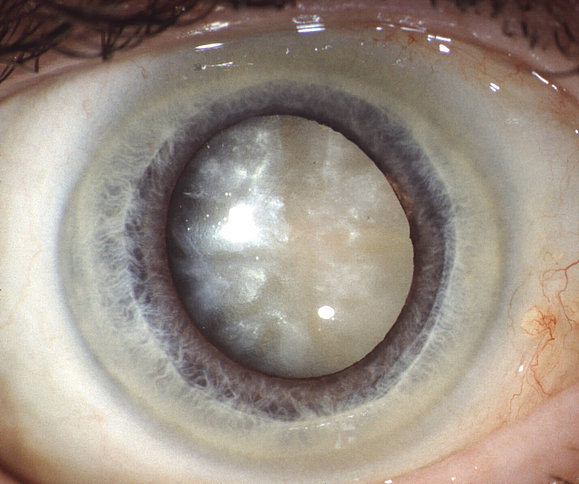 Foto eines Auges mit altersbedingtem Grauem Star