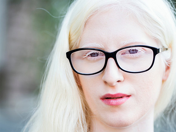 Am 13. Juni ist Internationaler Tag der Aufklärung über Albinismus Close-Up von Frau mit sehr hellen Haaren und Haut, die eine Brille trägt.