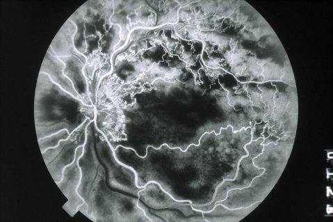 Abbildung eines Auges mit retinalem Venenverschluss