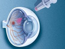 Schematische Darstellung einer Injektion ins Auge