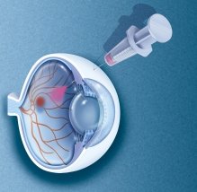 Schematische Darstellung einer Injektion ins Auge